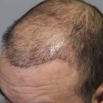 Swelling Back Of The Head After Hair Transplant