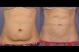 Ultrasound Cavitation Clinic in Abu Dhabi