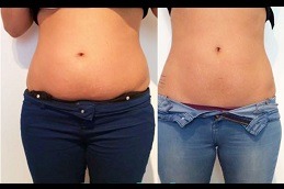 Ultrasound Cavitation Clinic in Dubai