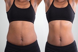 Ultrasound Cavitation in Dubai