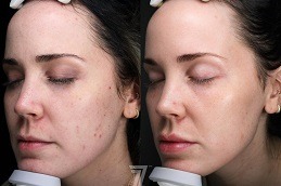 VISIA Skin Analysis Clinic in Abu Dhabi