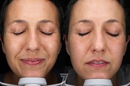 VISIA Skin Analysis Clinic in Dubai & Abu Dhabi