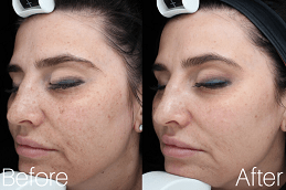 VISIA Skin Analysis in Dubai