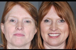 What Are The Advantages Of Laser Skin Resurfacing Clinic in Abu Dhabi