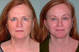 What Are The Advantages Of Laser Skin Resurfacing Clinic in Dubai