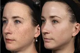 What Are The Advantages Of Laser Skin Resurfacing in Dubai