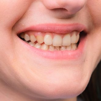 What Vitamin Deficiency Causes Yellow Teeth?
