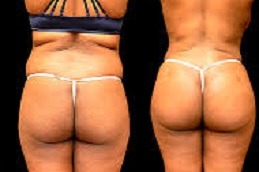 Where Can You Find A Buttocks Lift Clinic in Abu Dhabi