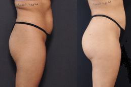 Where Can You Find A Buttocks Lift Clinic in Dubai & Abu Dhabi