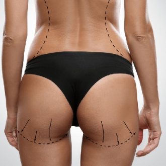 Where Can You Find A Buttocks Lift In Dubai?