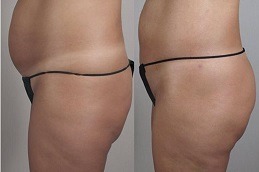 Where Can You Find A Buttocks Lift in Dubai