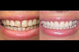 Why Do We Need Cosmetic Dentistry Treatments in Dubai