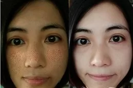 Why Does Glutathione Cause Acne Breakouts?