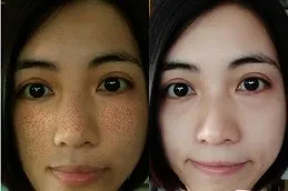 glutathione skin purging Why Does Cause Acne Breakouts In Dubai & Abu Dhabi Denominations:$500.00 Delivery Method_Lozenges THE B12 STORE @