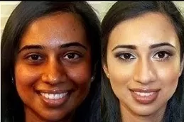 Why Does Glutathione Cause Acne Breakouts in Dubai