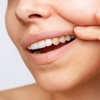 Will My Teeth Be Sensitive After Laser Teeth Whitening?