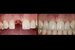 Zygomatic Implants Clinic in Abu Dhabi