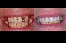 Zygomatic Implants Clinic in Dubai Sports