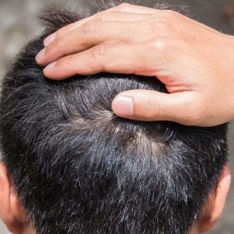 A Tight Feeling In The Scalp During A Hair Transplant