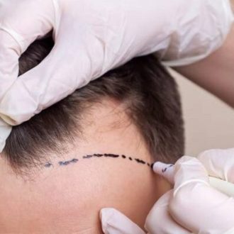 Achieve Permanent Hair Restoration With FUE Procedure