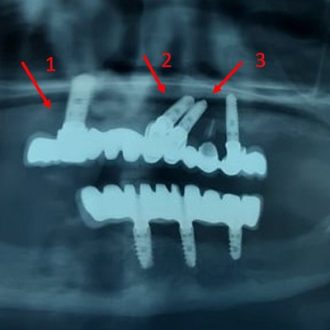 Advantages And Disadvantages Of Full Mouth Rehabilitation?