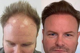 Best A Tight Feeling In The Scalp During A Hair Transplant Clinic in Dubai