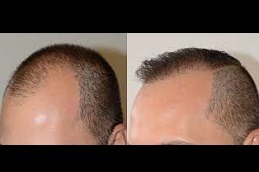 Best A Tight Feeling In The Scalp During A Hair Transplant in Dubai