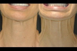 Best Botox For Neck Wrinkles Is It Right For You in Dubai
