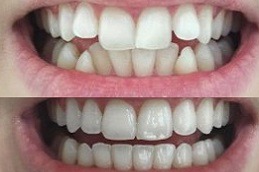 Best Can Invisalign Help You Achieve A Perfect Smile Clinic in Dubai