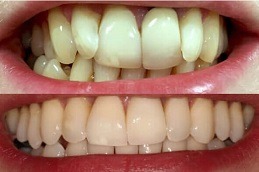 Best Can Invisalign Help You Achieve A Perfect Smile in Dubai
