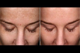 Best Does Laser Treatment Really Work For Skin Brightening Clinic in Dubai