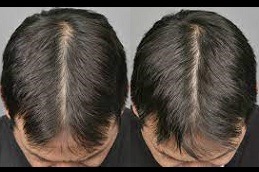 Best PRP Injections For Hair Loss Near You Clinic in Dubai