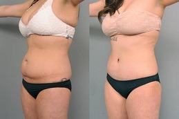 Best Tummy Liposuction Cost Clinic dubai - Copy