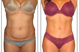 Best Tummy Liposuction Cost Dubai - Copy