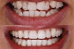 Can Invisalign Help You Achieve A Perfect Smile in Dubai