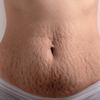 Can Laser Treatments Really Get Rid Of Stretch Marks?