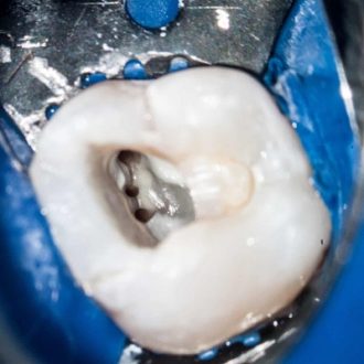 Can Multiple Teeth Need Root Canals?