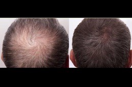 PRP Injections For Hair Loss Near You in Dubai