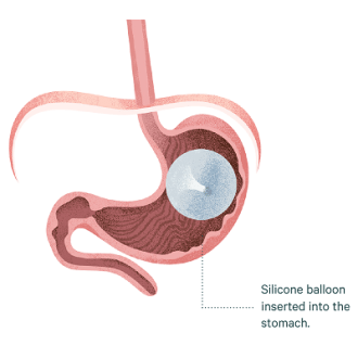 Safe And Effective Swallowable Gastric Balloon