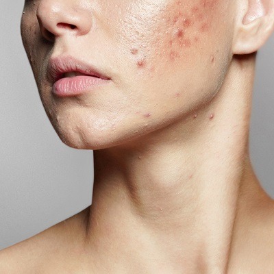 Say Goodbye To Hormonal Acne With Quick And Effective Treatment