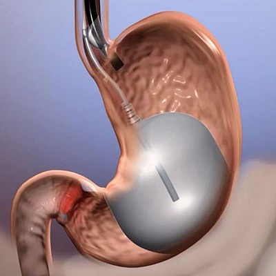What Are The Uses And Side Effects Of Gastric Balloons