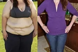 What Are The Uses And Side Effects Of Gastric Balloons in Dubai