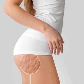 What Is The Latest Breakthrough In Cellulite Treatments?