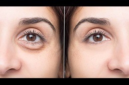 Best Brighten Your Eyes Effective Dark Circles Treatment Solutions in Dubai