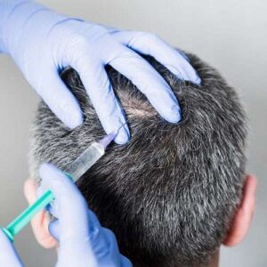 Best Hair Restoration Procedures For Thicker, Fuller Hair And Hair Fall