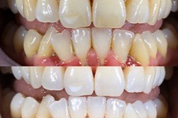 Best Is Teeth Cleaning Safe For Teeth in Dubai