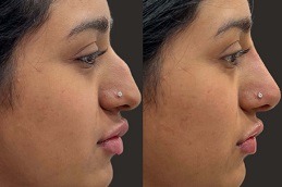 Best Permanent Non-Surgical Nose Job in Dubai