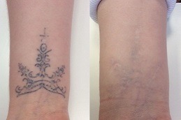 Best Safe And Efficient Laser Tattoo Removal in Dubai