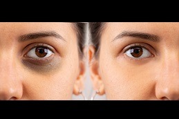 Brighten Your Eyes Effective Dark Circles Treatment Solutions in Dubai