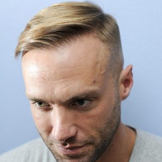 Celebrity Hair Transplants: Who Has Had Them And Why?